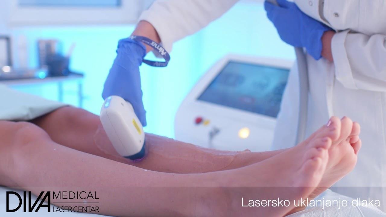 Laserska epilacija nogu