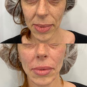 korekcija bora oko usana upotreba hijaluronski fileri korekcija bora oko usana hijaluronskim filerima